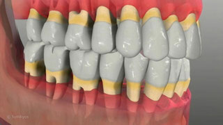 Fluoride Trays for Exposed Tooth Roots