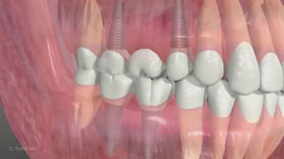 Dental Implants (Compilation)