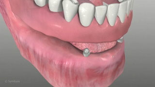 Dental Implants, Temporary Minis for Dentures