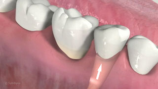 Lengthening Teeth by Extrusion