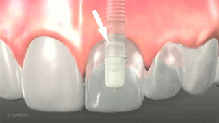 Dental Implants and Cantilevered Pontics