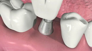 Dental Implants and Single Crowns