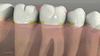 Tooth Decay Between Teeth