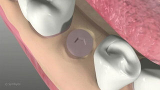 Dental Implants, Osseointegration