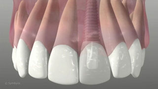 Dental Implants, Immediate Tooth Replacement