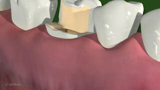 Options for Badly Damaged Teeth