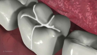 Dental Sealants and Fissurotomy