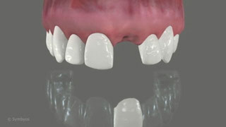 Tooth Replacement, Clear Appliance