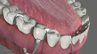 Dentures, Removable Partial