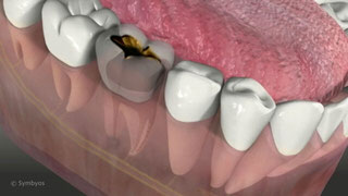 Dental Abscesses