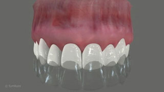 Tooth Whitening With Trays
