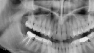 Dental Radiographs, Panoramic